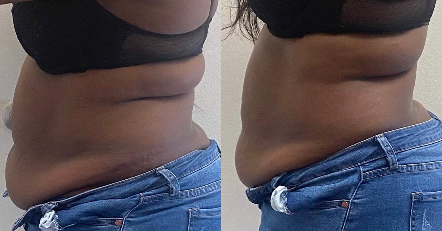 Fat Melting Package