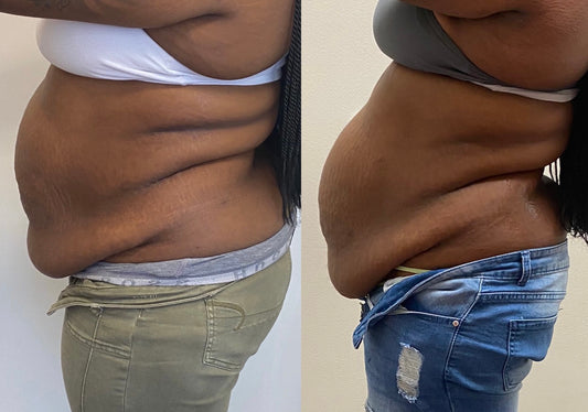 Fat Melting Package