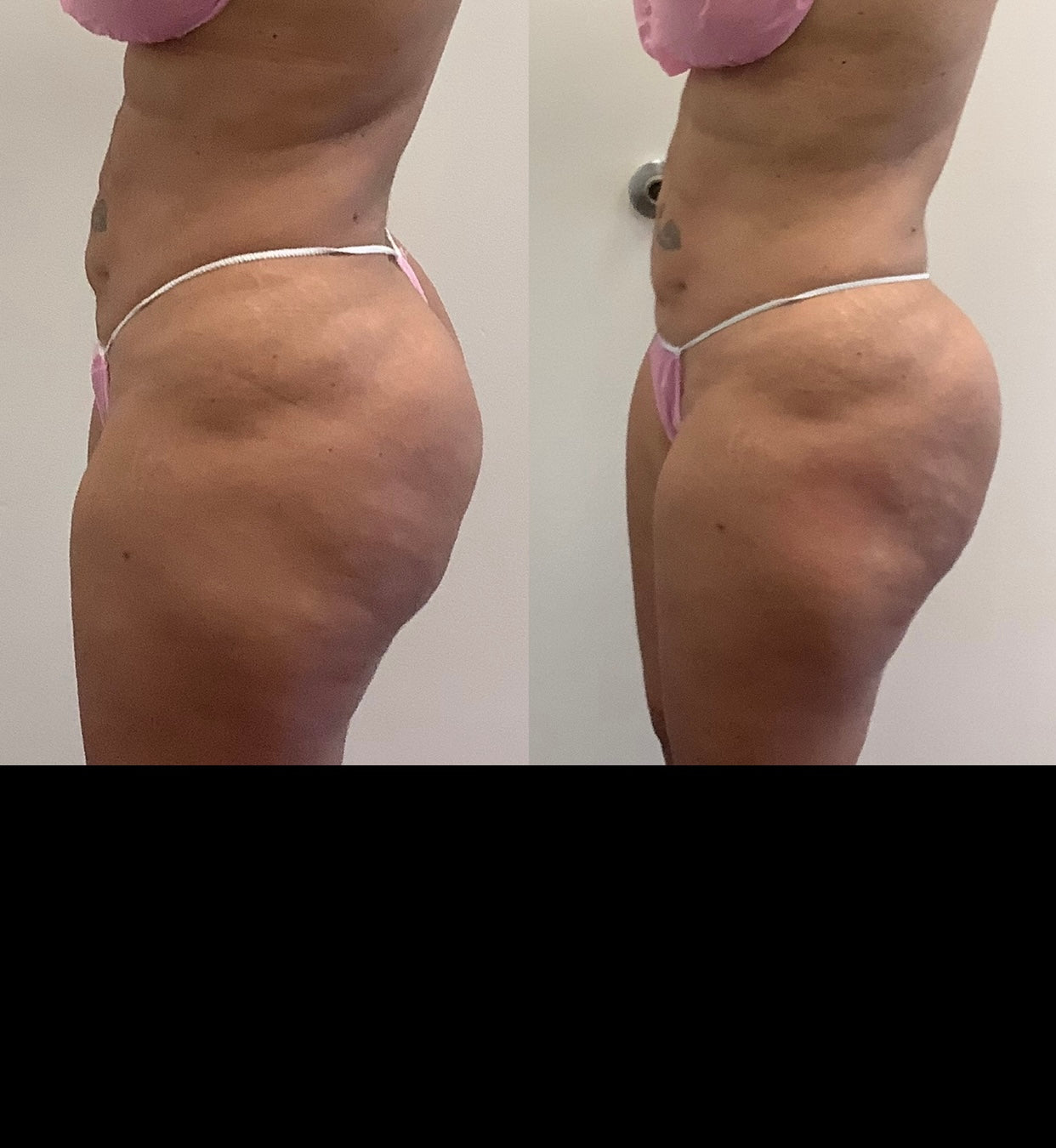 Fat Melting Package