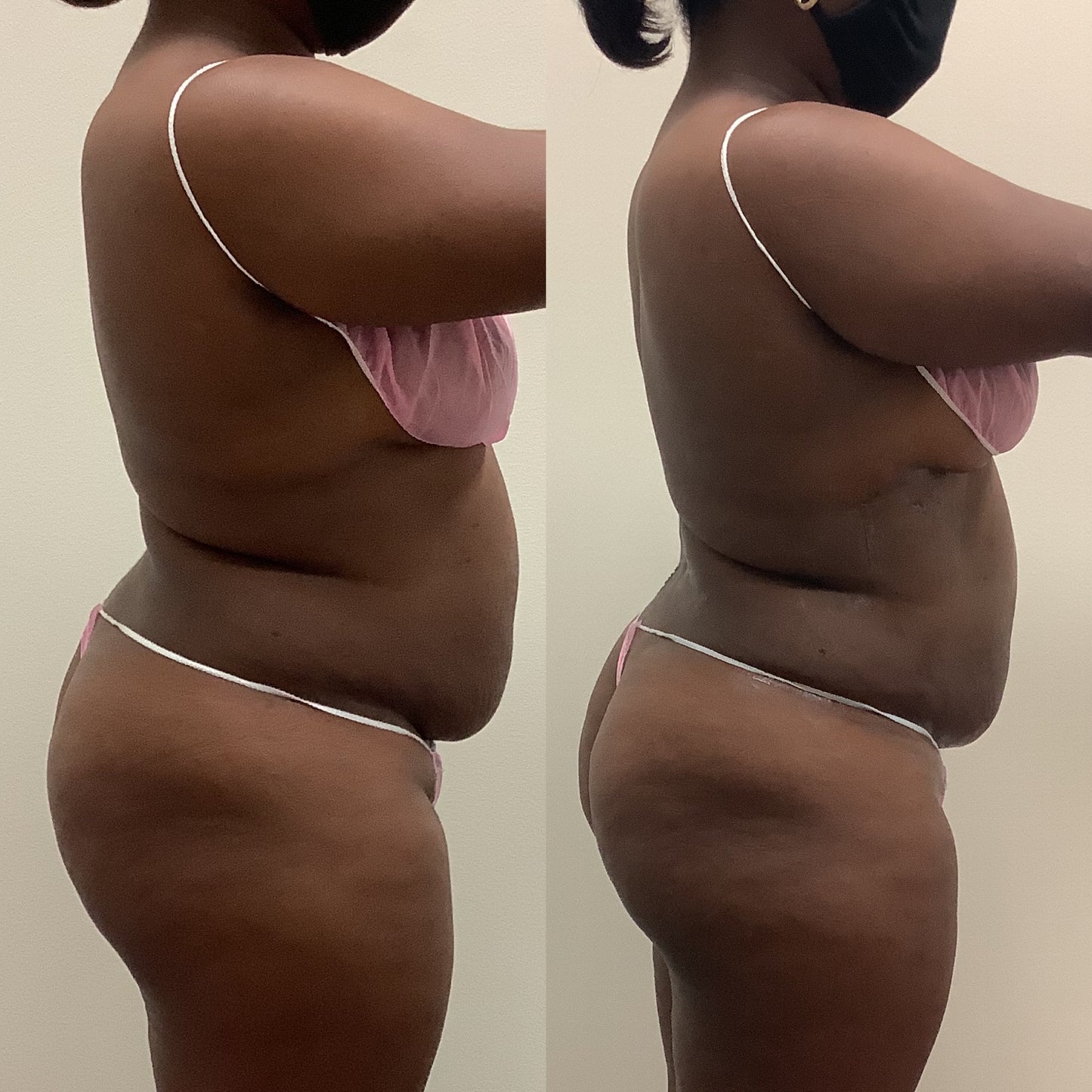 Fat Melting Package