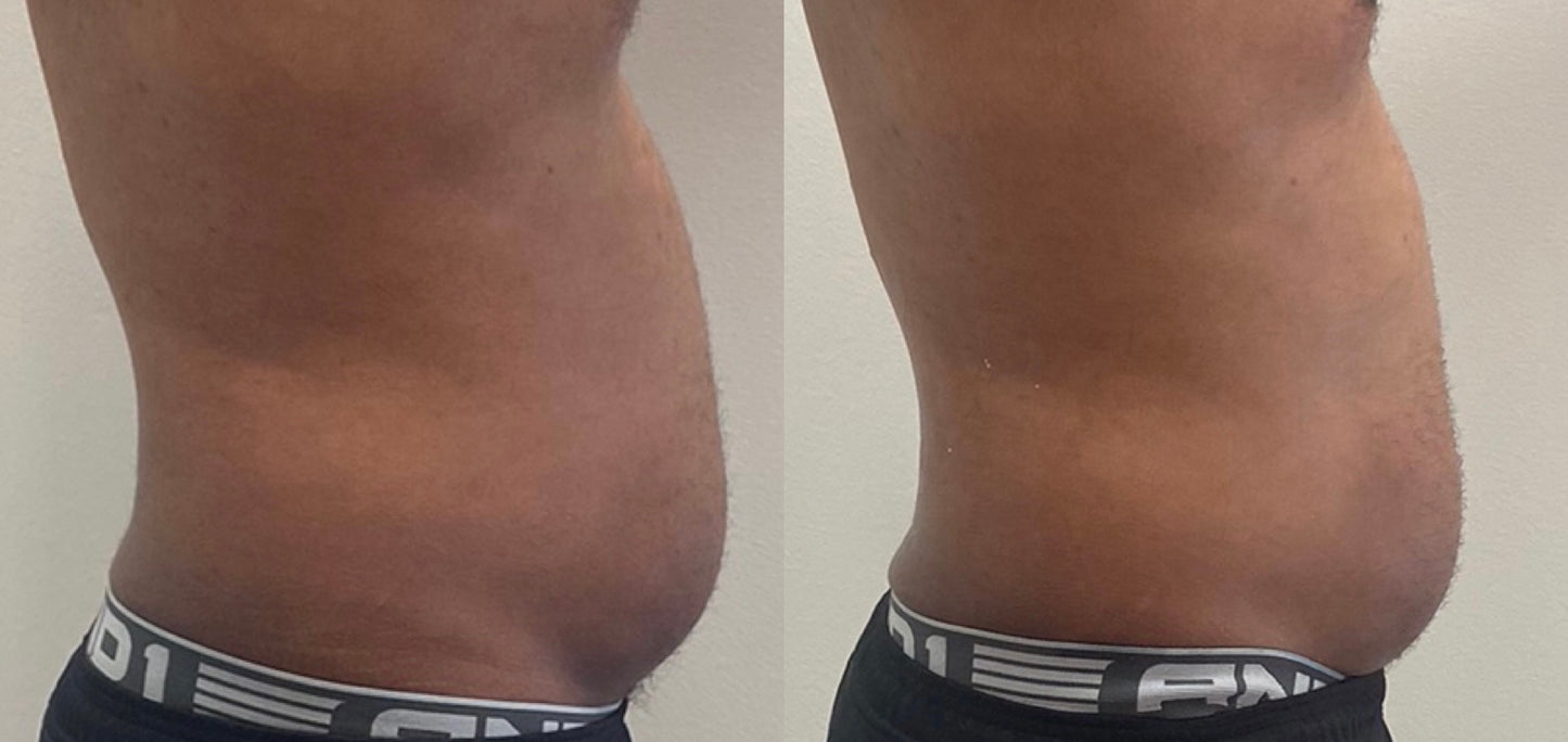 Fat Melting Package